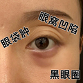 眼窝凹陷修复去眼袋眼霜黑眼圈去除神器特别严重黑眼圈去除泪沟s