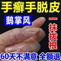 手癣膏真菌感染手脱皮药膏手足癣鹅掌风汗疱疹手掌手指头干裂脱皮